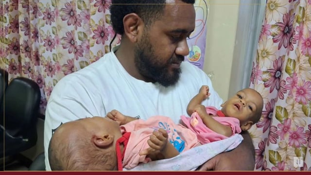 بعد أن طلبت 3 دول مليون دولار.. السعودية تتكفل مجانًا بفصل توأم سيامي من فيجي