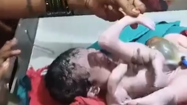 حالة نادرة.. ولادة طفل بأربعة أذرع وأربعة أرجل