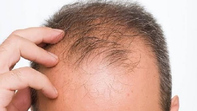 أدوية لإنقاص الوزن ترتبط بزيادة خطر تساقط الشعر لدى الرجال