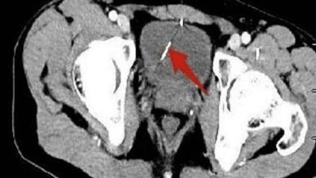 واقعة غريبة.. إبرة خياطة في قلب رجل صيني دون أعراض