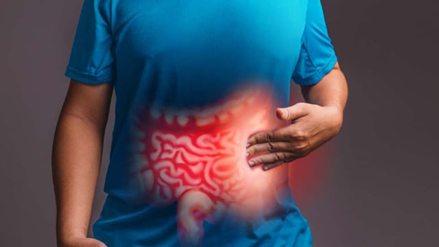 دراسة حديثة: استئصال الزائدة الدودية الملتهبة قد يقلل خطر الإصابة بسرطان القولون