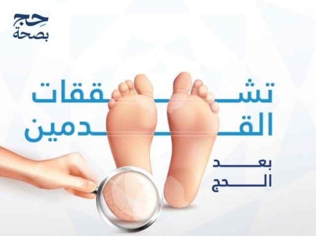 بعد الحج.. 4 أعراض تكشف الإصابة بتشققات القدمين وإرشادات للعناية